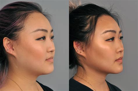 Buccal Fat Removal (Cheek Reduction) in Seattle & Bellevue.